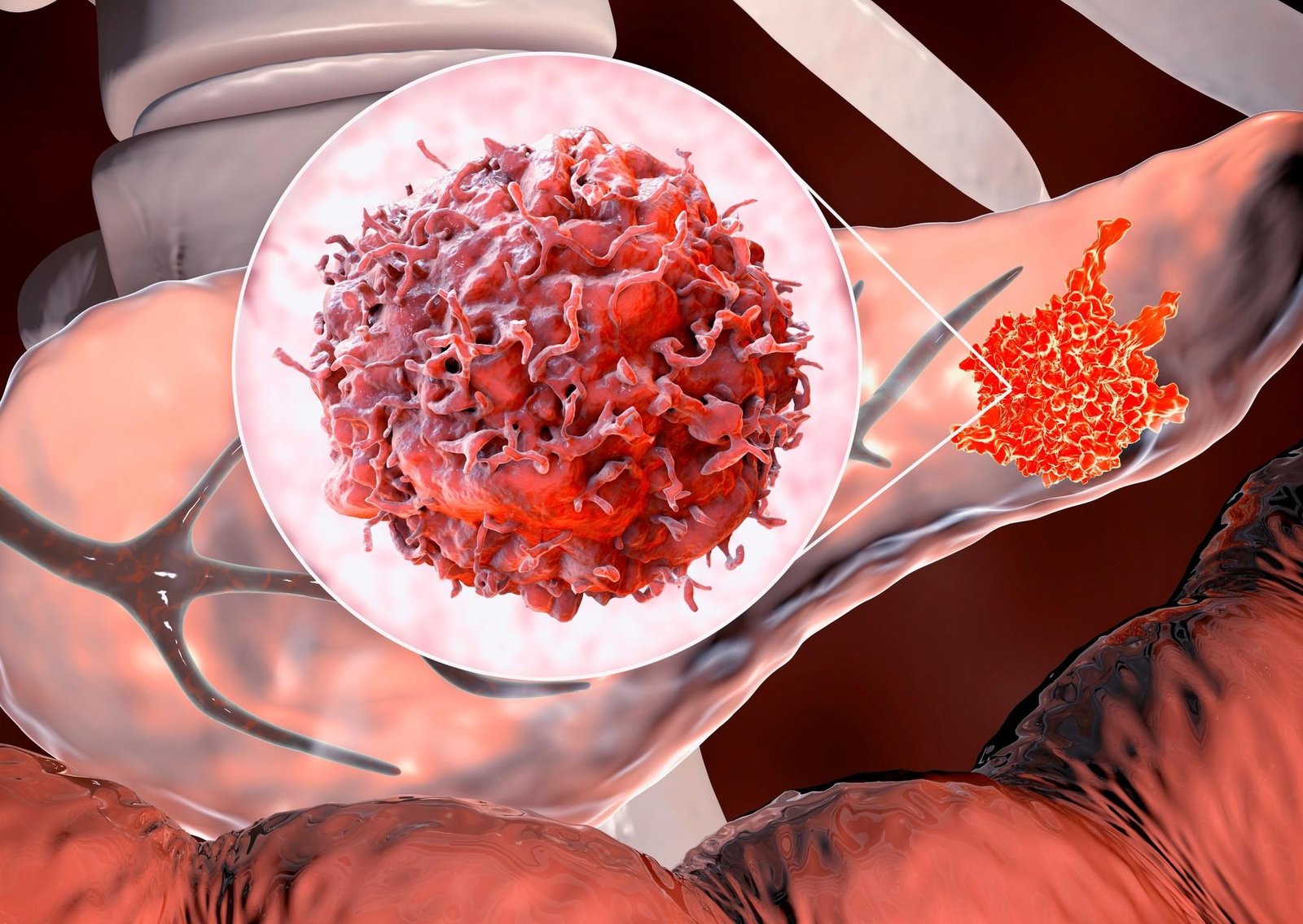 Cáncer de páncreas: de los desafíos a la esperanza