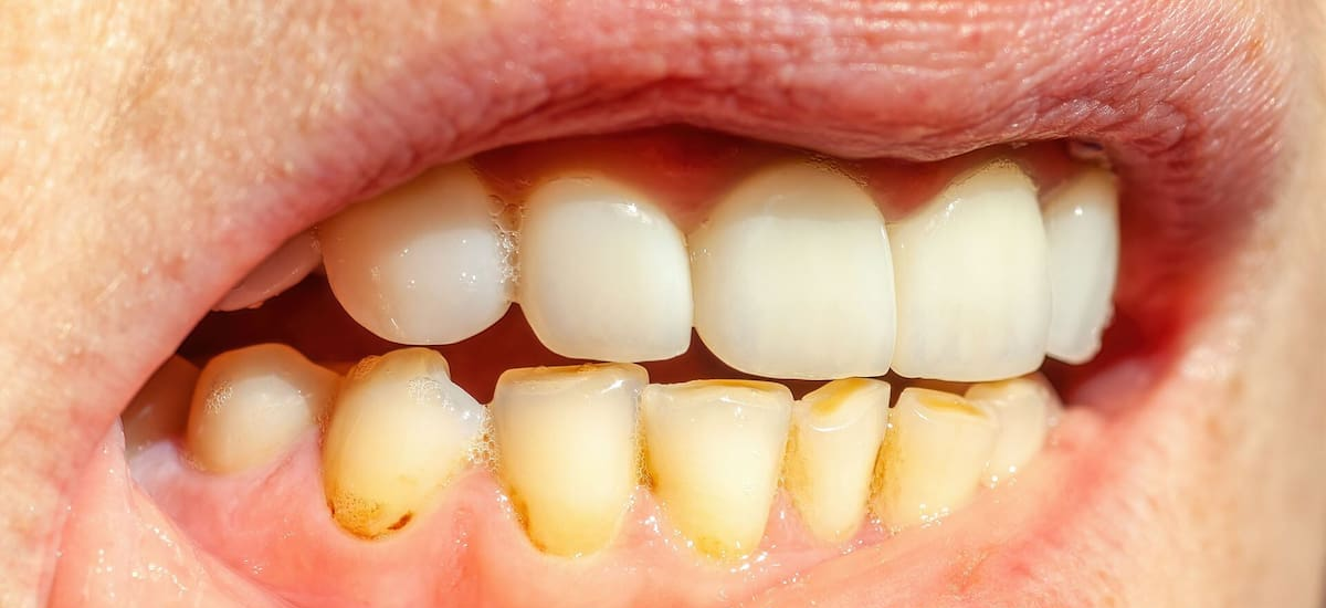Ni bicarbonato ni vinagre: el truco para sacar el sarro de los dientes y dejarlos blancos - El Cronista