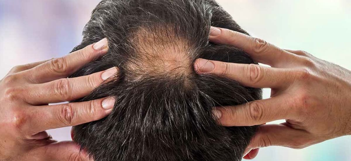 La sencilla y veloz solución para la calvicie: este es el tratamiento casero que contribuye a evitar la caída del cabello