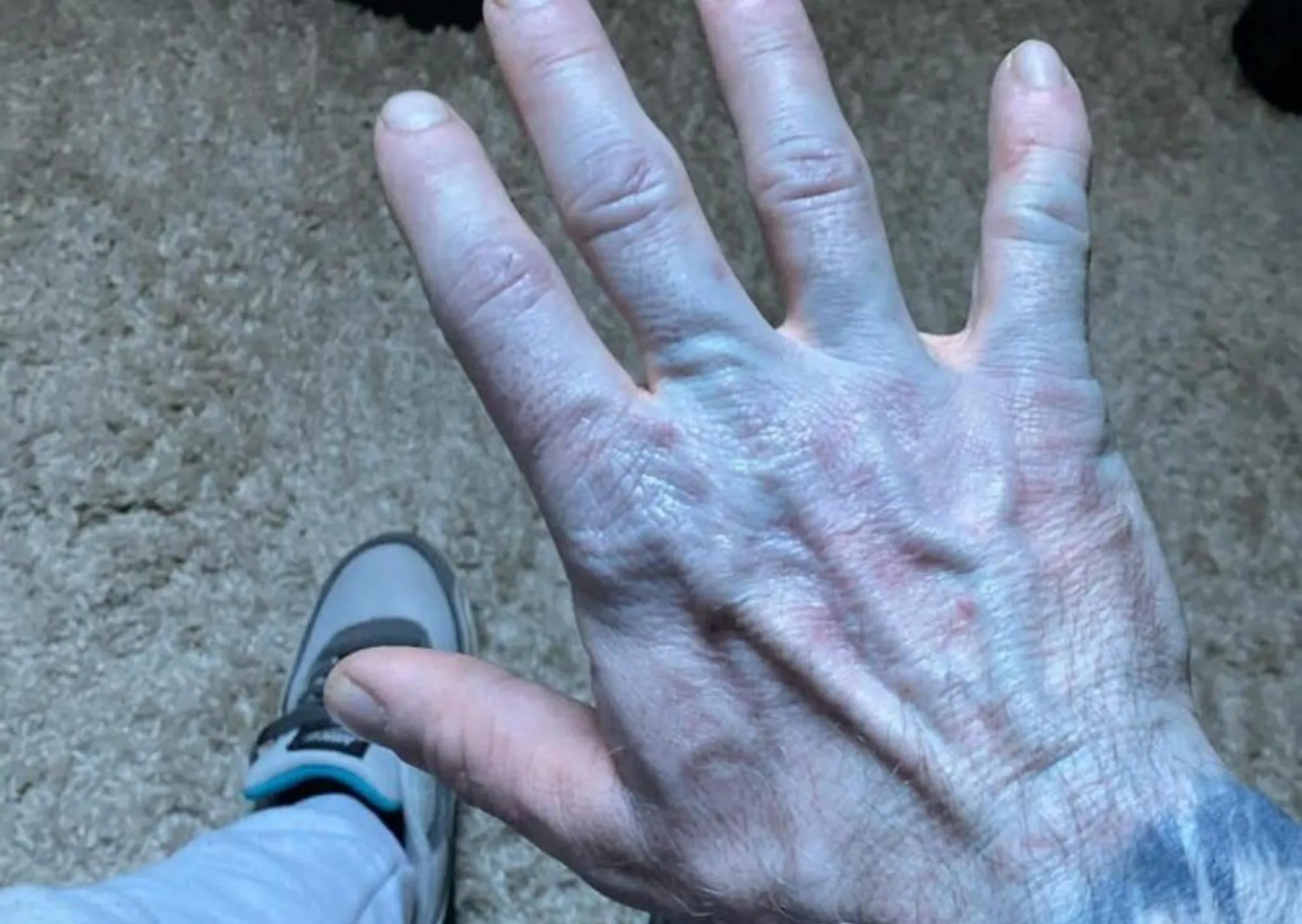 Se despertó con la piel azul y en el hospital descubrió la inesperada causa: "Me sentí avergonzado"