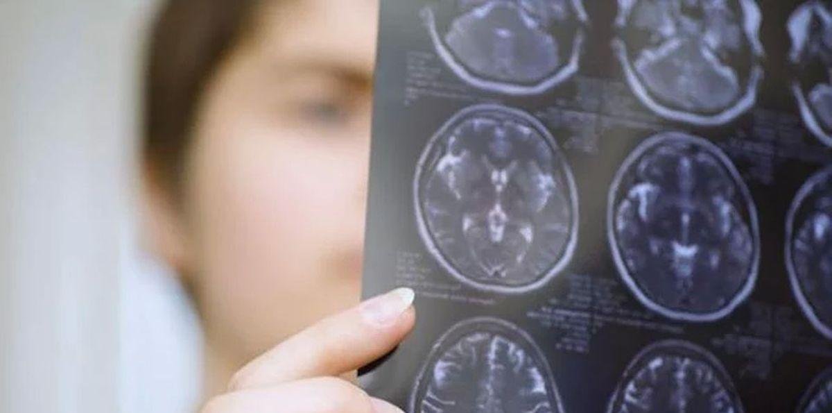 La diferencia entre ELA y esclerosis múltiple a pesar de sus síntomas similares