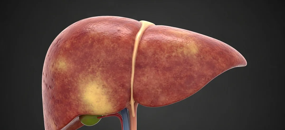 Dos factores cotidianos pueden desencadenar hígado graso en hombres, alerta un nuevo estudio