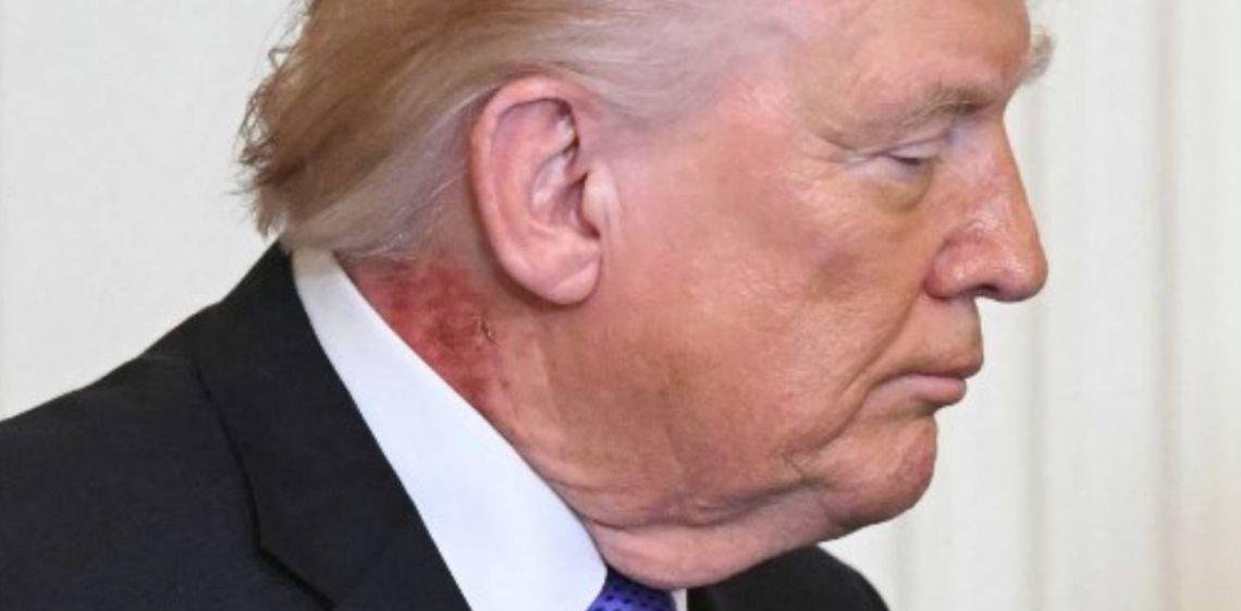 Donald Trump y la mancha roja en el cuello, qué es la queratosis actínica