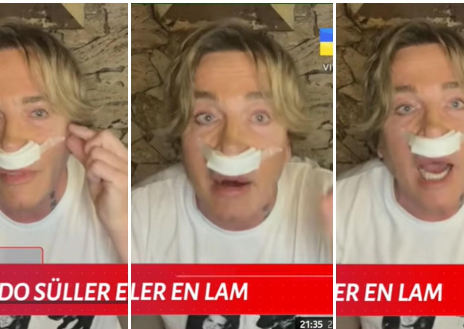 La cirugía estética que se realizó Guido Süller a los 64 años para parecerse a una estrella de Hollywood