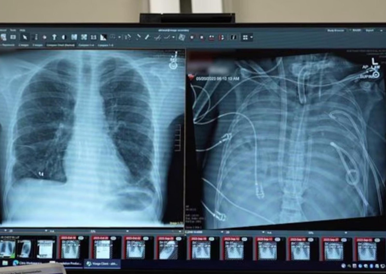 El hombre que vivió 48 horas sin pulmones