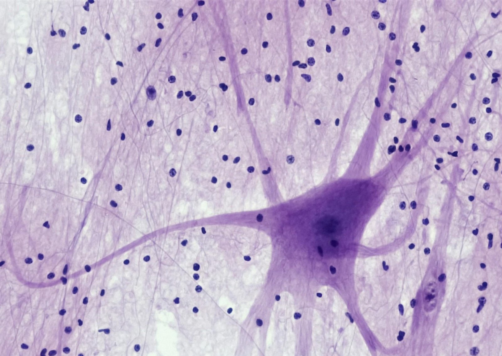 Revelan la estrategia contra el Alzheimer que combina fármacos y un diagnóstico precoz