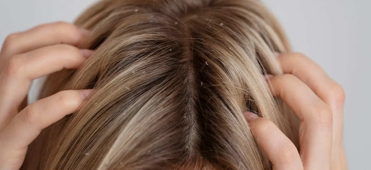 Las causas que puede haber detrás del picor en el cuero cabelludo más allá de la caspa: del hipotiroidismo al estrés